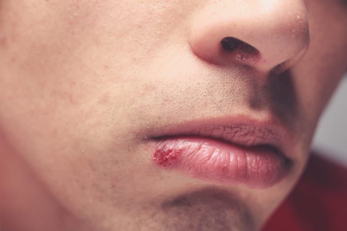 How exactly to Treat a Cold Sore